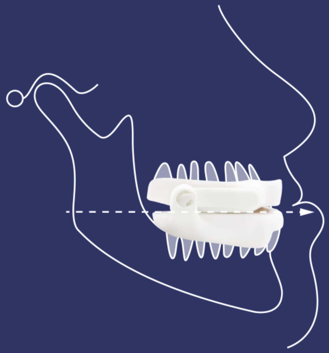 Line drawing of a jaw with a standard mandibular advancement device moving the lower jaw forward
