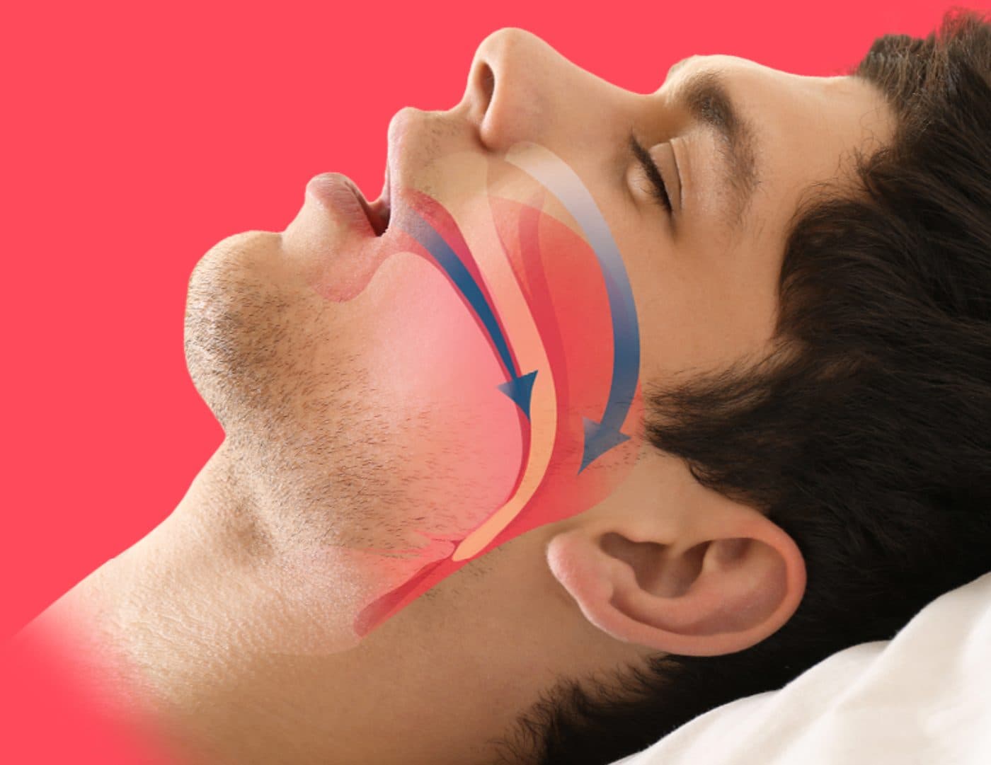Illustration of a sleeping man’s airway showing where it collapses during obstructive sleep apnea